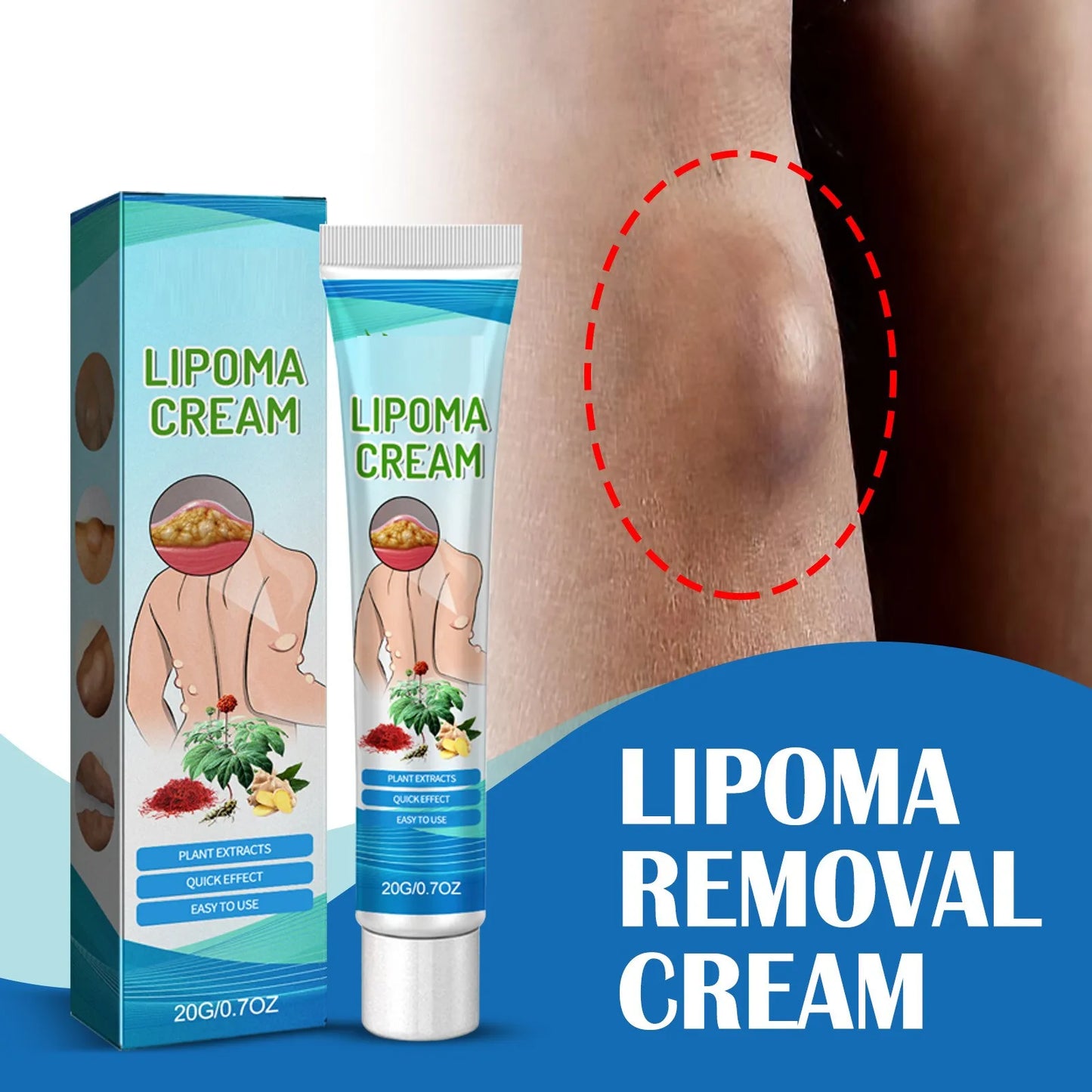 Natural Herbal Lipoma Removal Ointment 🌐