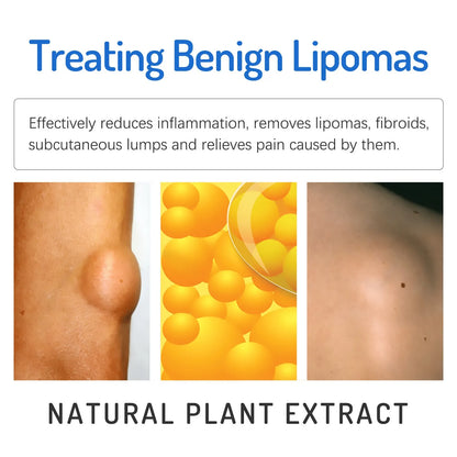 Natural Herbal Lipoma Removal Ointment 🌐